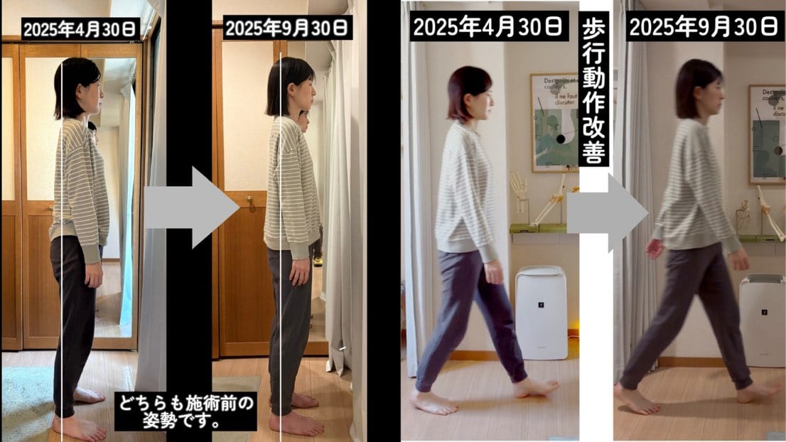 下北沢整体サロンリーニア姿勢・歩行改善ビフォーアフター。