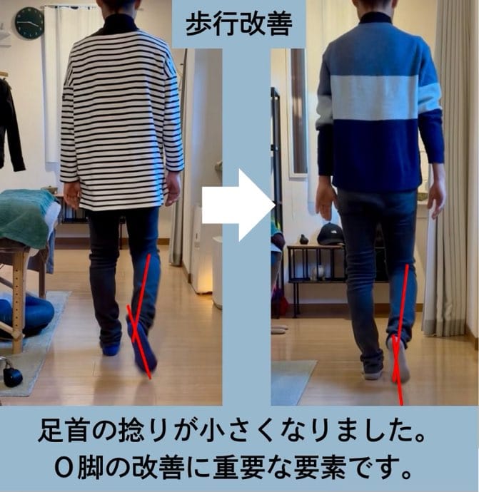 30代、左肩と腰と右足首の痛み、O脚にお悩みの方の姿勢矯正・歩行改善施術例・歩行改善。