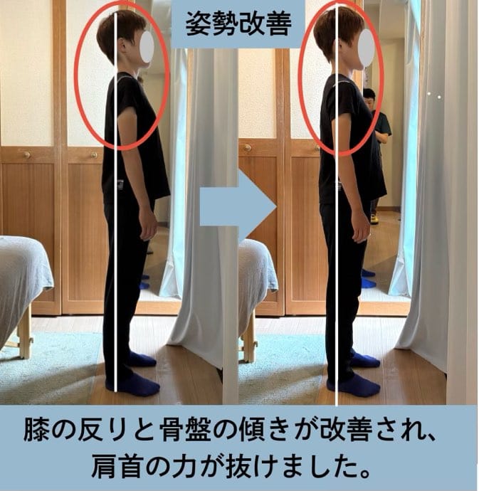 30代、左肩と腰と右足首の痛み、O脚にお悩みの方の姿勢矯正・歩行改善施術例・姿勢改善。