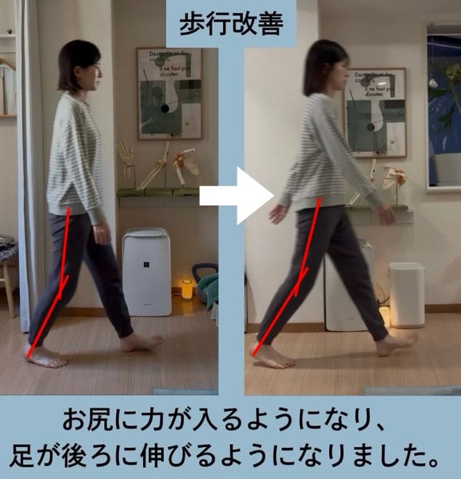 40代、左肩と腰と外反母趾の痛み、猫背にお悩みの方の姿勢矯正・歩行改善施術例・歩行改善。