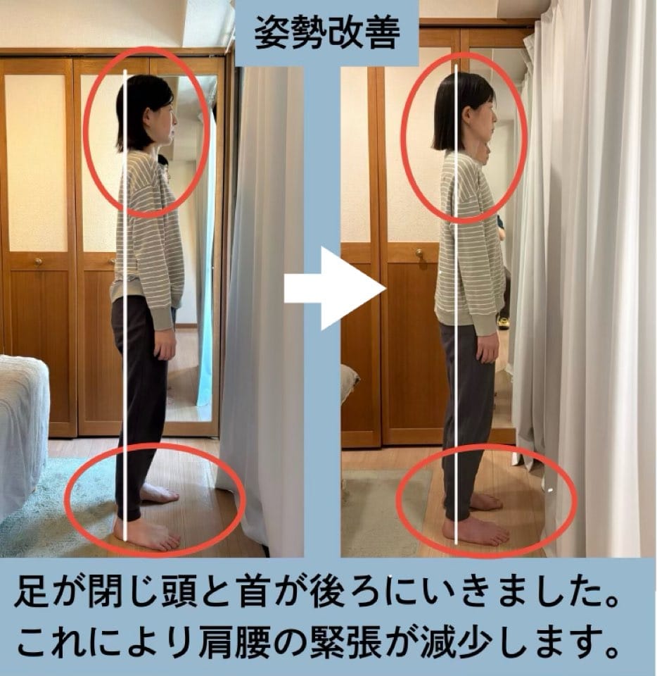 40代、左肩と腰と外反母趾の痛み、猫背にお悩みの方の姿勢矯正・歩行改善施術例・姿勢改善。