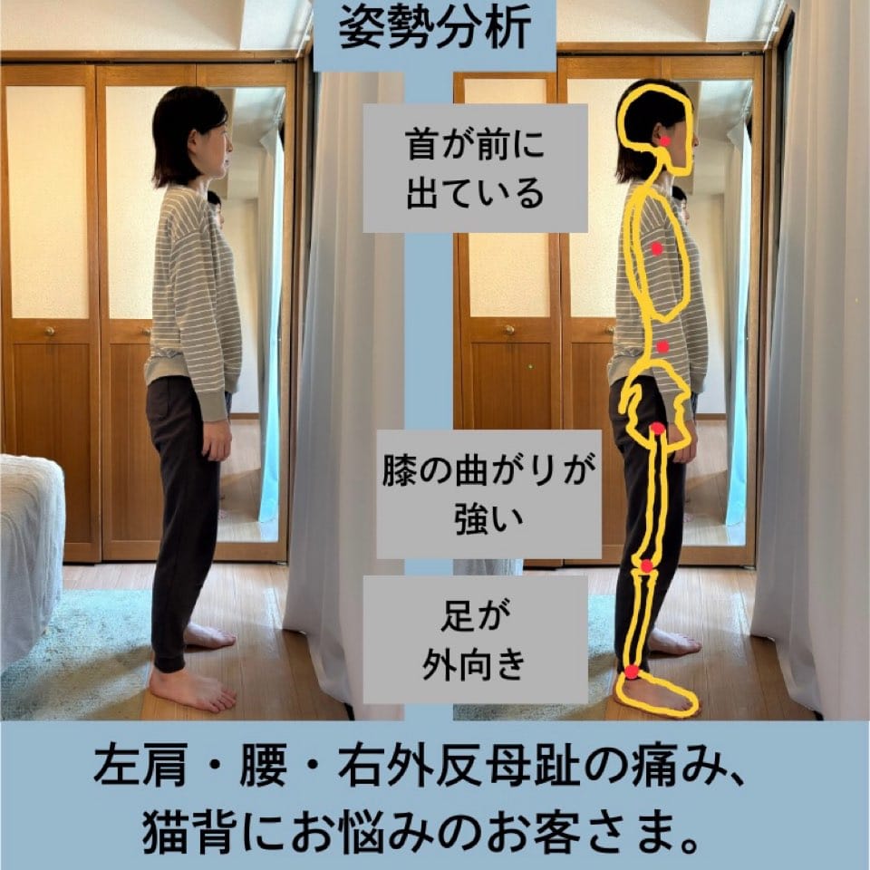 40代、左肩と腰と外反母趾の痛み、猫背にお悩みの方の姿勢矯正・歩行改善施術例・姿勢分析。