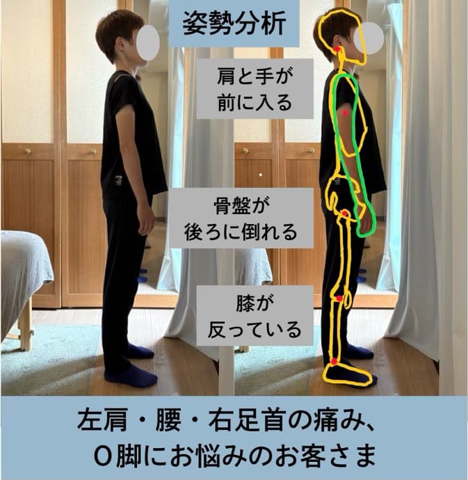30代、左肩と腰と右足首の痛み、O脚にお悩みの方の姿勢矯正・歩行改善施術例・姿勢分析。